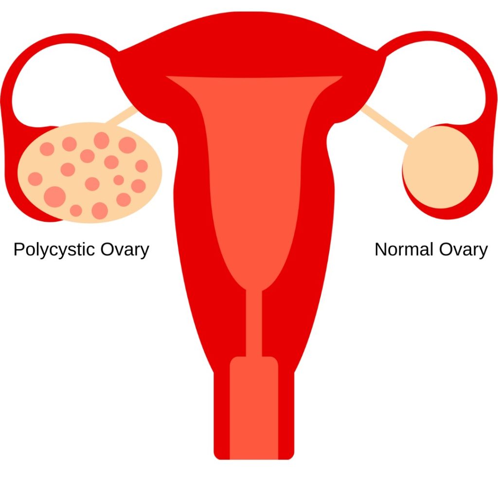 Polycystic Ovary Syndrome Pcos Or Polycystic Ovarian Disease Pcod Emedica